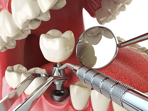 Best Dental Abscess Treatment in Porter, IN